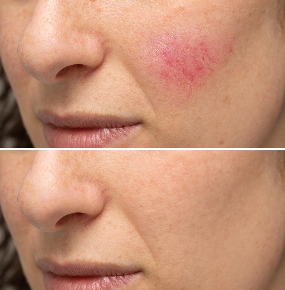 Résultat traitement rosacée couperose IPL — avant après